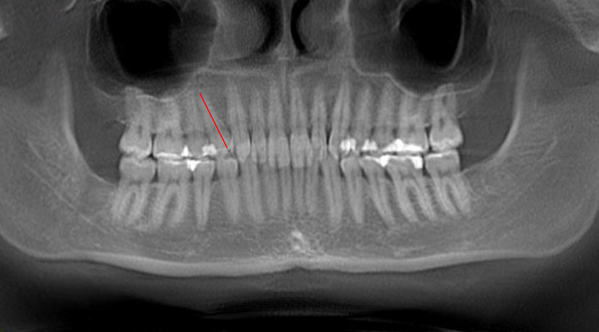 панорамный снимок зубов