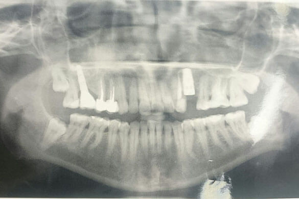 Рентгеновский снимок с имплантантом