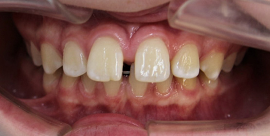 Диастема между передними зубами