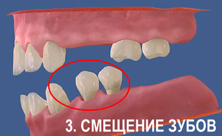Изменения при отсутствии зуба