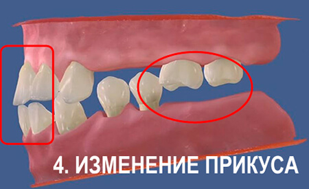 Изменения при отсутствии зуба