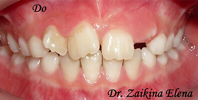 До лечения на ортодонтических пластинках