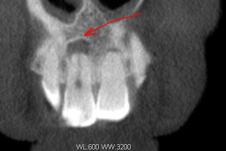 киста зуба на рентгене