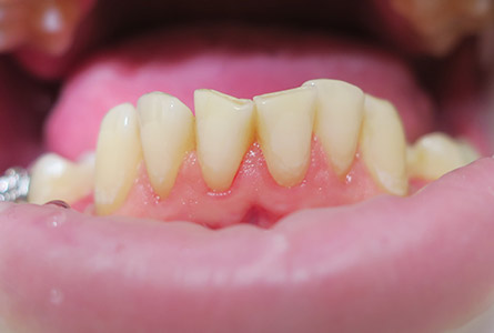 стоматологический клей на зубах