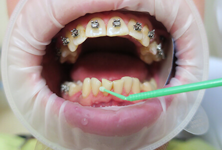 нанесение стоматологического клея