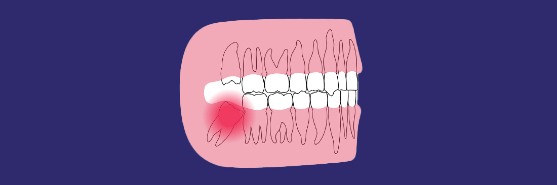 Что такое ретенированные зубы?