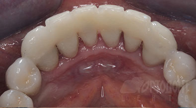 Коронки на зубах нижней челюсти с шинированием