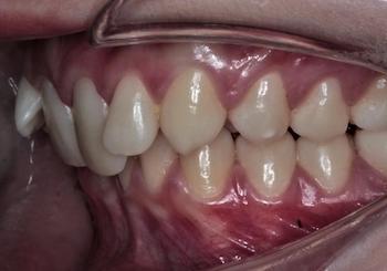 смыкание зубов