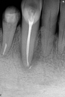 снимок зуба в процессе лечения