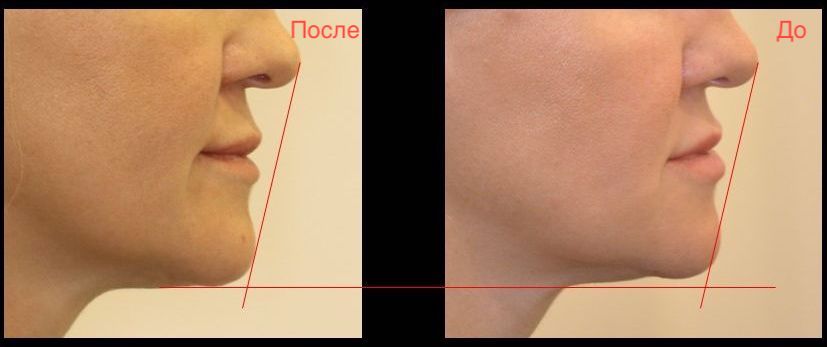 Улучшение положения нижней челюсти после протезирования