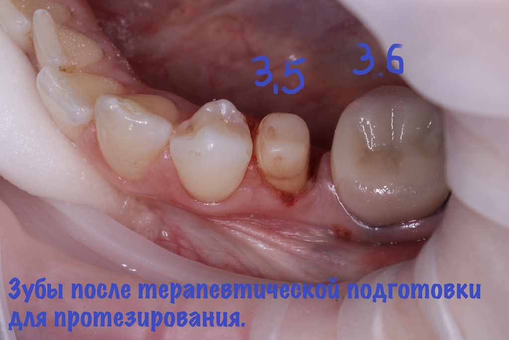 Зубы после терапевтической подготовки для протезирования