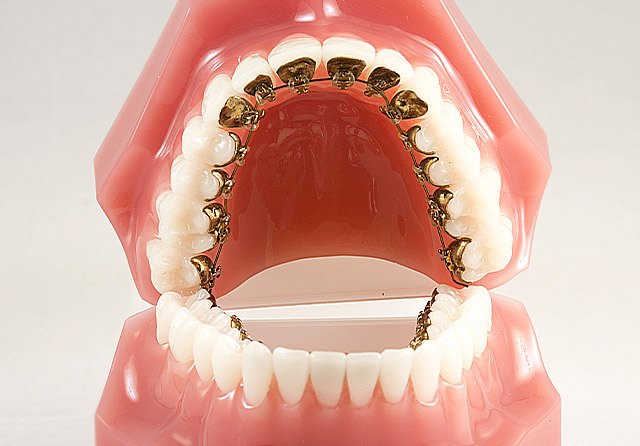 Брекеты инкогнито на зубах