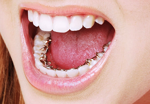 Брекет-система incognito на зубах