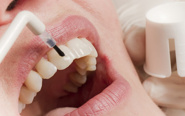 фторирование и ремотерапия зубов