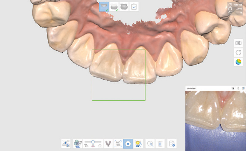 3д-сканирование зубов