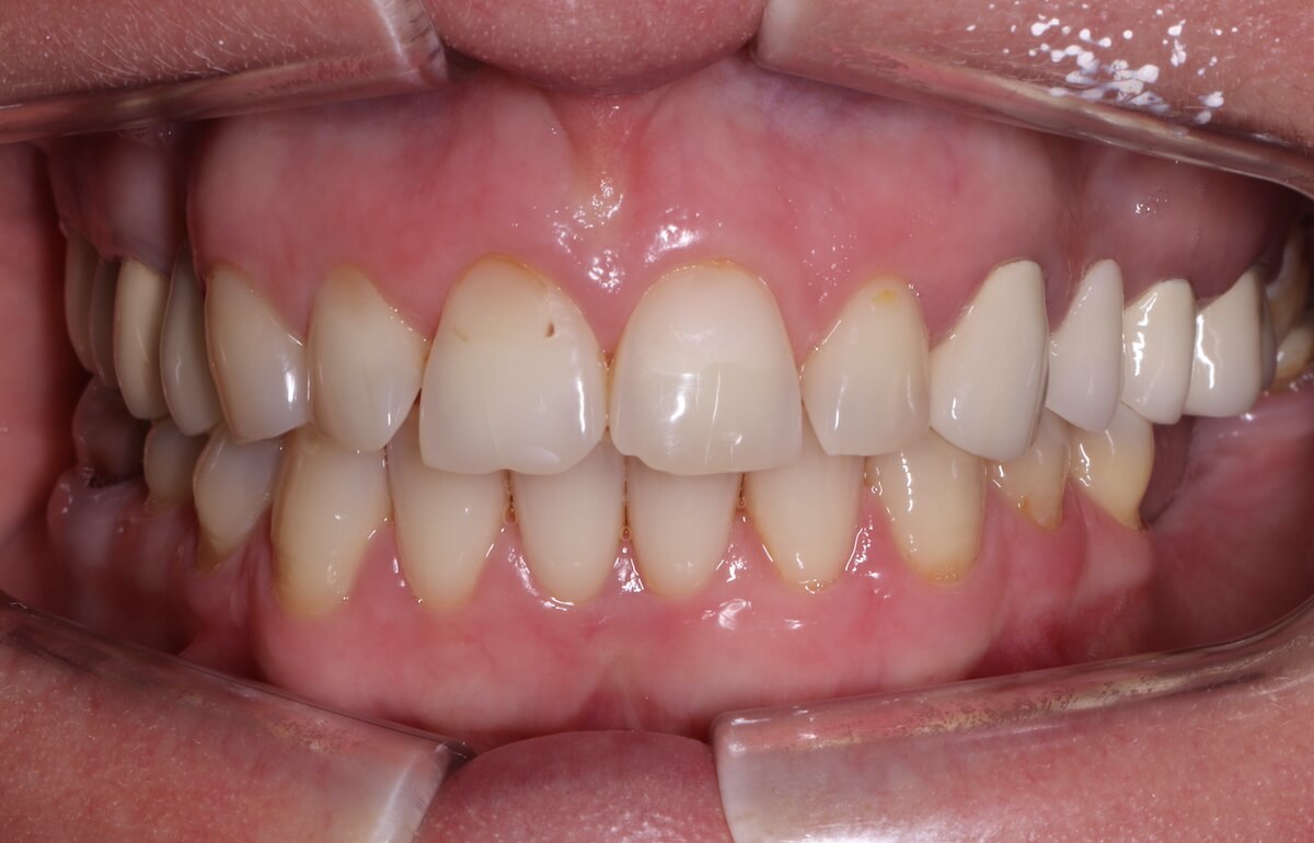 Зубы перед лечением