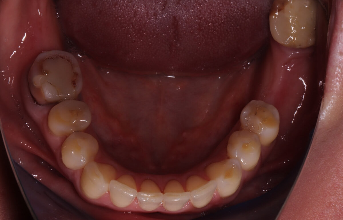 Зубы перед лечением