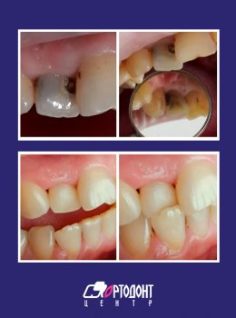 Лечение / Реставрация зубов — Фрыгина Марина Владимировна, лечение реставрация